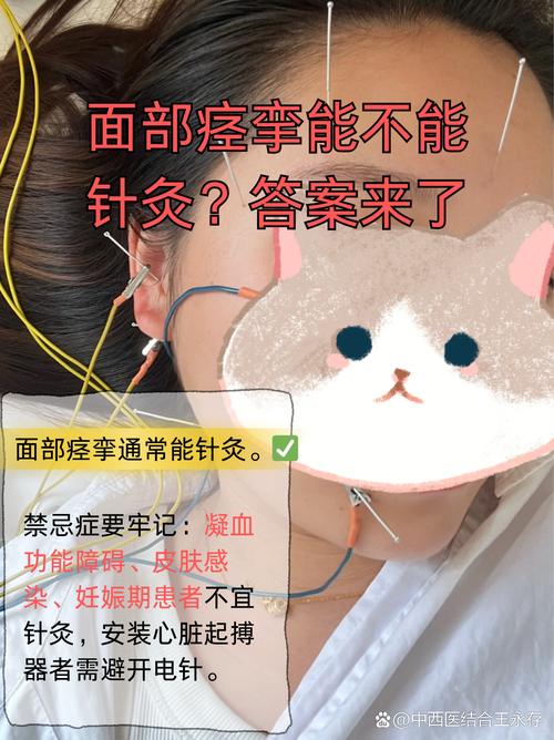 眼脸痉挛可以针灸吗