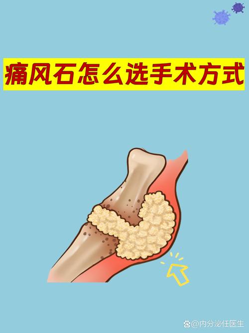 痛风石手术多久能好