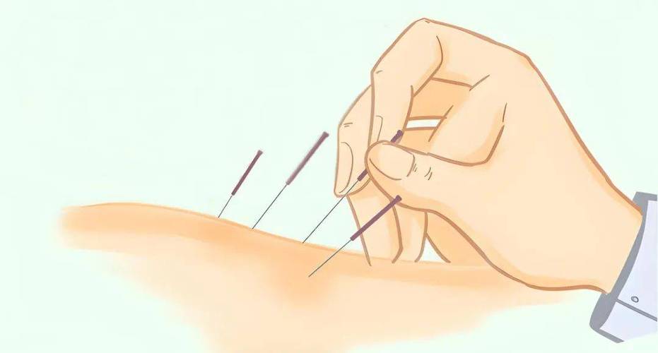 腹部针灸减肥穴位图