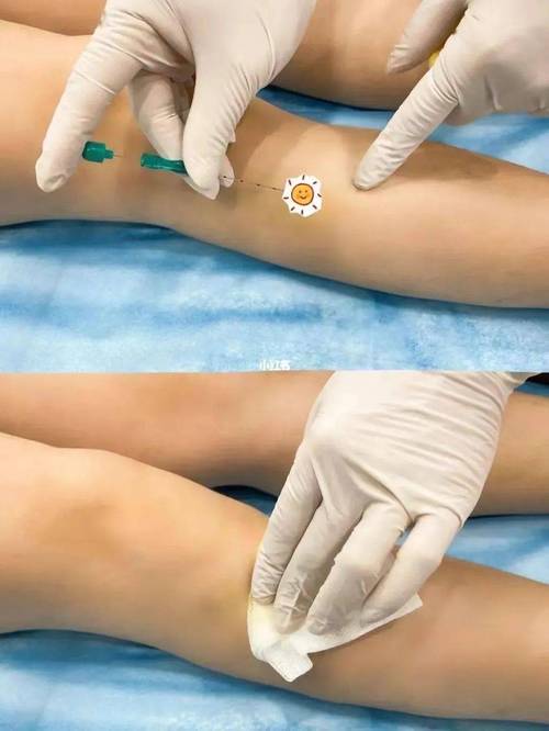 腹部针灸减肥穴位图