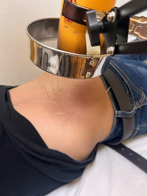 臀部肥胖可以针灸吗