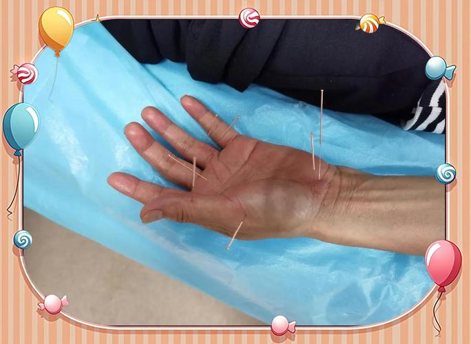 肌腱损伤可以针灸吗