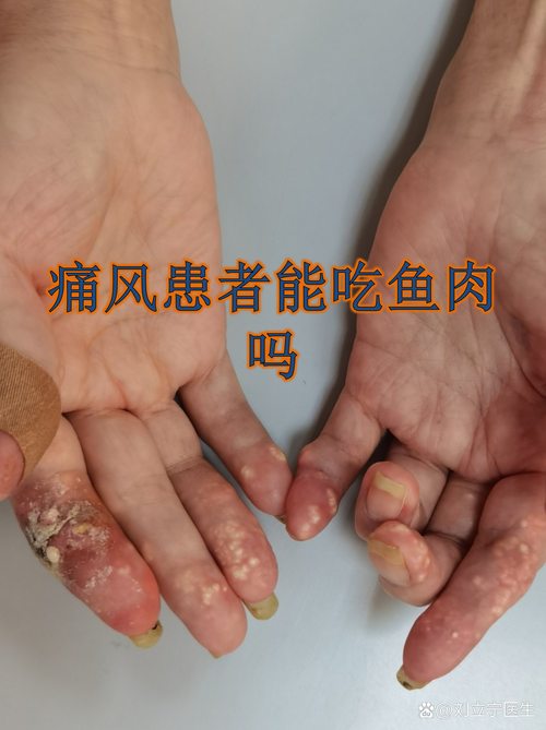 痛风可以吃生鱼片吗