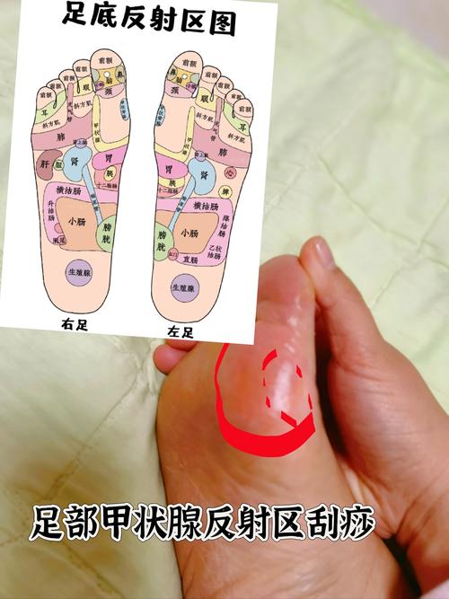 脚底穴位可以针灸吗