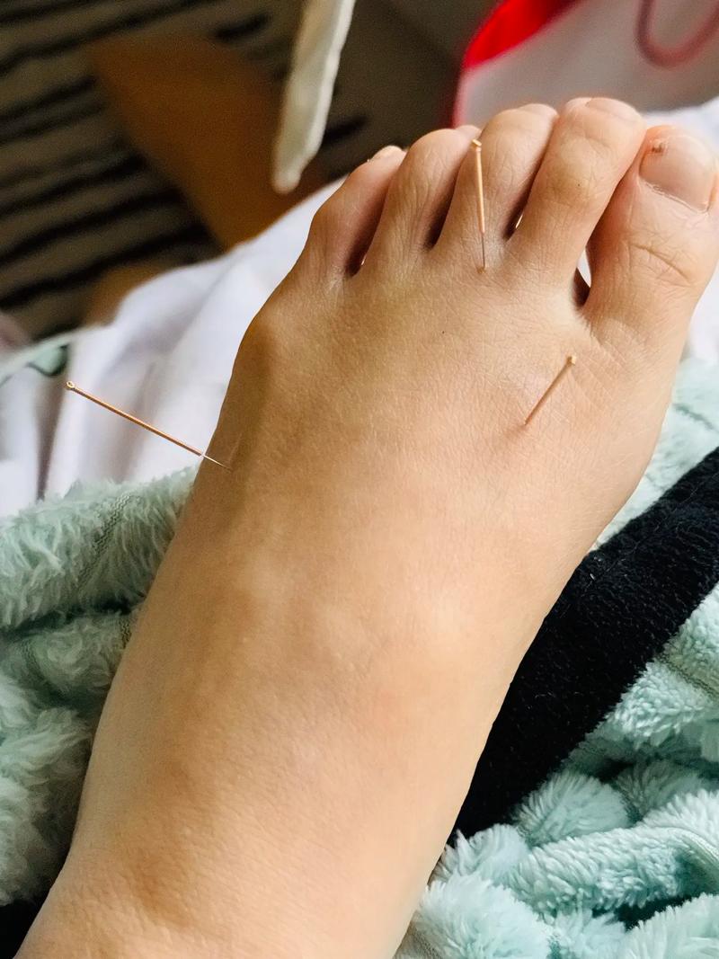 脚底穴位可以针灸吗