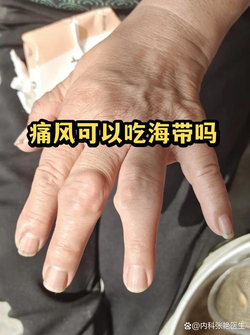 痛风病人能否吃海带