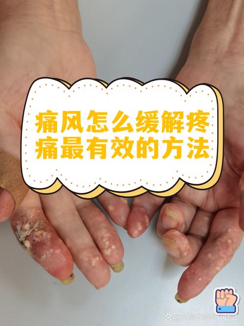 痛风和心脏有关系吗