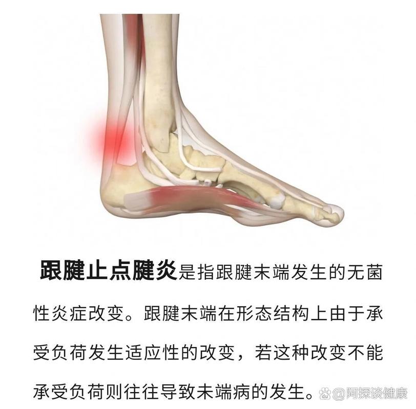 跟腱炎跟痛风的区别