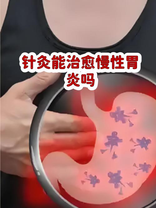 慢性胃炎可以针灸吗