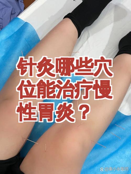 慢性胃炎可以针灸吗