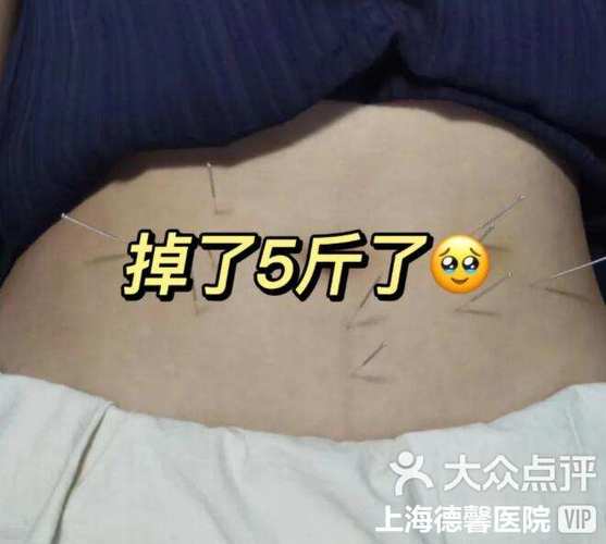 昆明针灸减肥哪里好