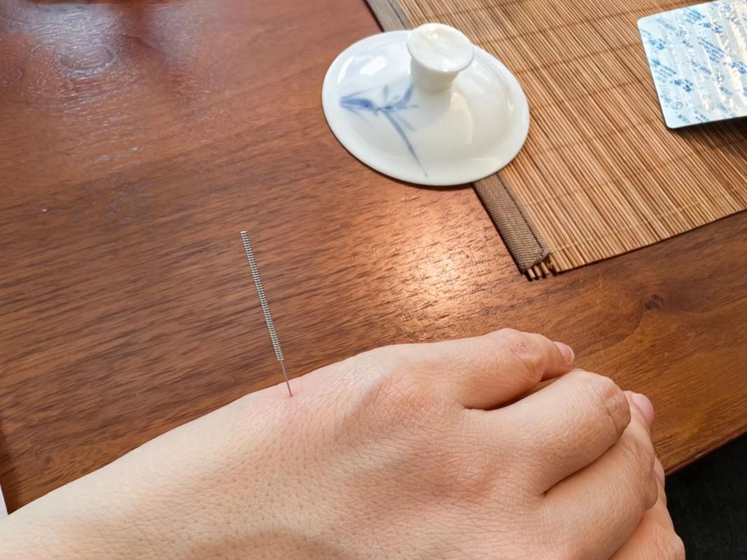 宁波针灸减肥哪里好