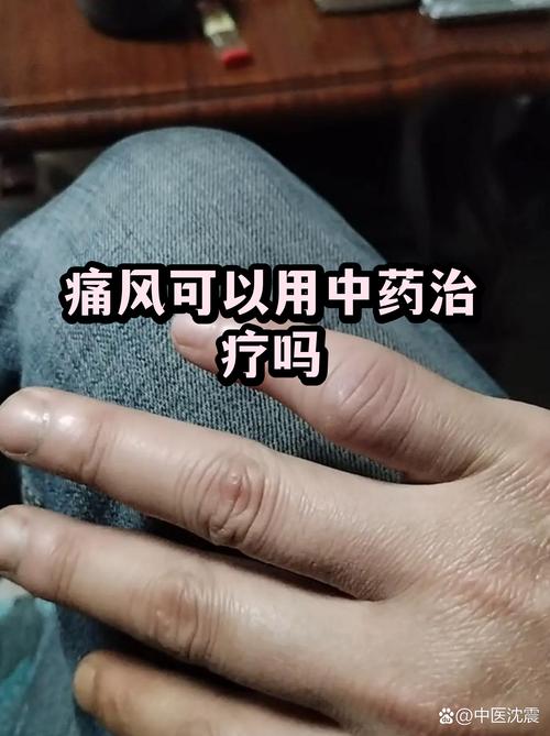 正骨医院能治痛风吗