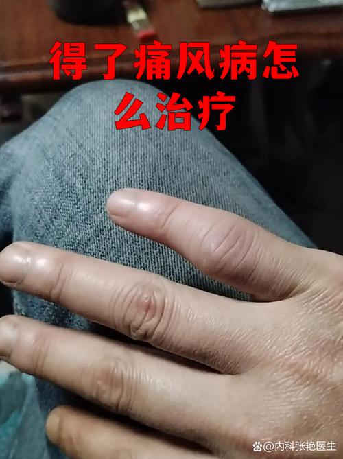 正骨医院能治痛风吗