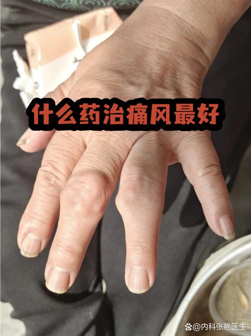 正骨医院能治痛风吗