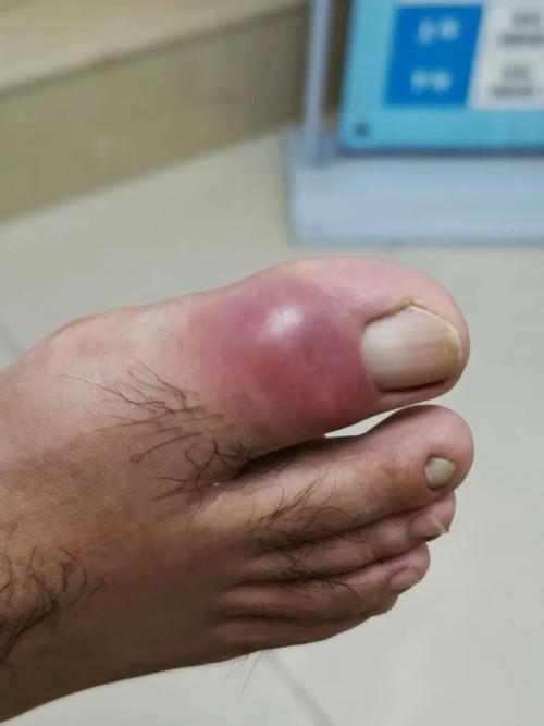 痛风消肿后走路还疼