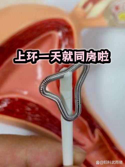 上环一个月同房安全吗