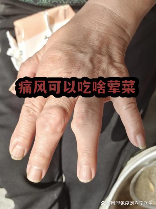 痛风可以吃萝卜菜吗