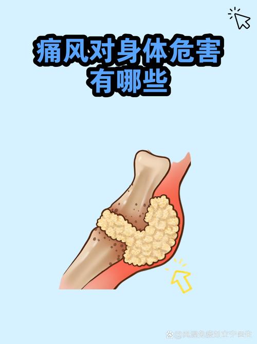 高血压和痛风谁严重