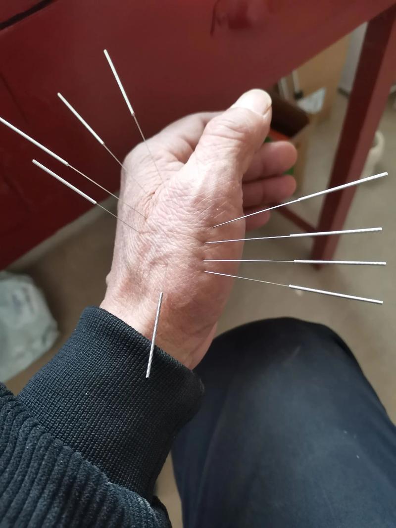 宝鸡谁扎针灸hao