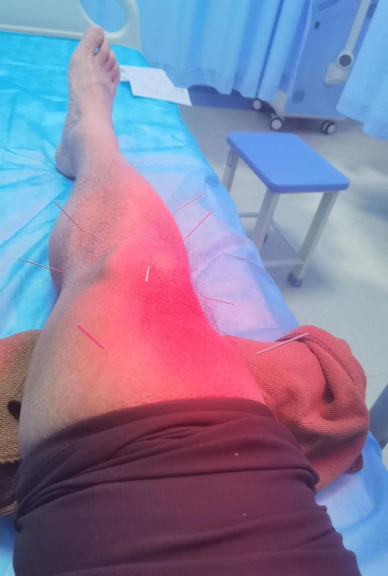 尿酸高中医针灸治疗