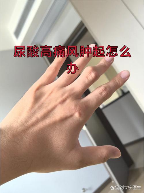 尿酸高痛风能喝酒吗