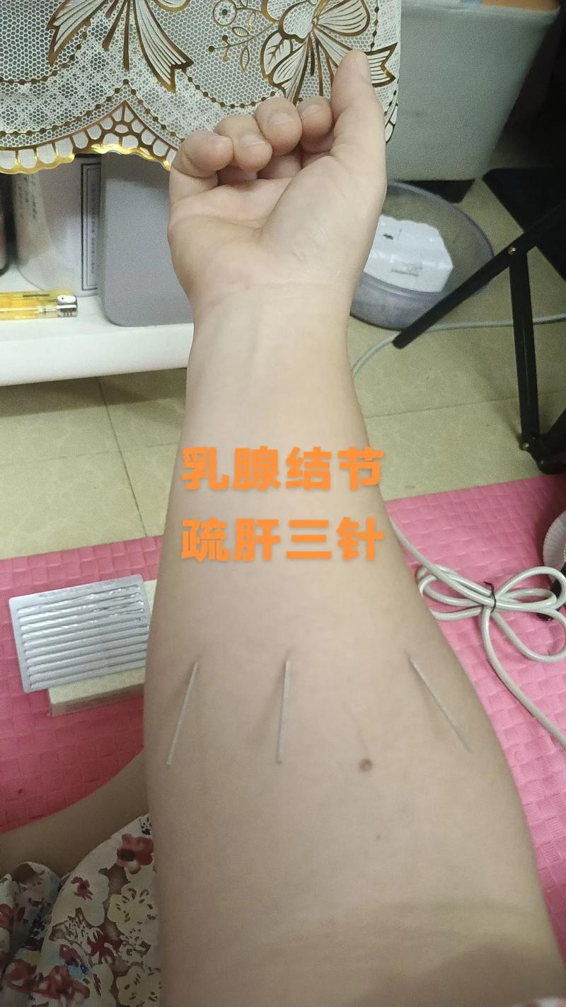 中医针灸可以丰胸吗