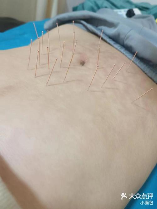 衡阳哪里有针灸减肥