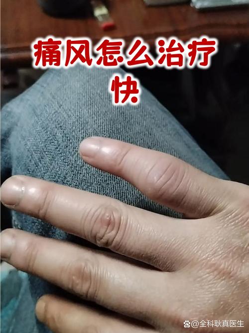 看痛风首选上海长江