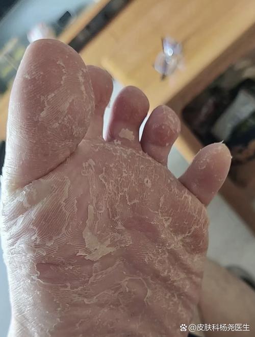 花椒水泡脚治痛风吗