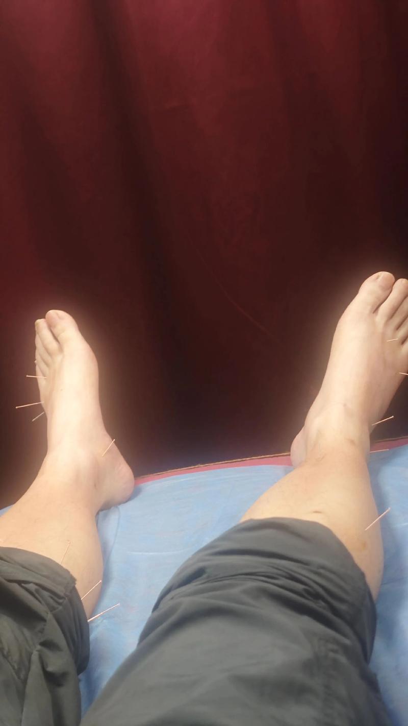 左脚发麻的针灸穴位