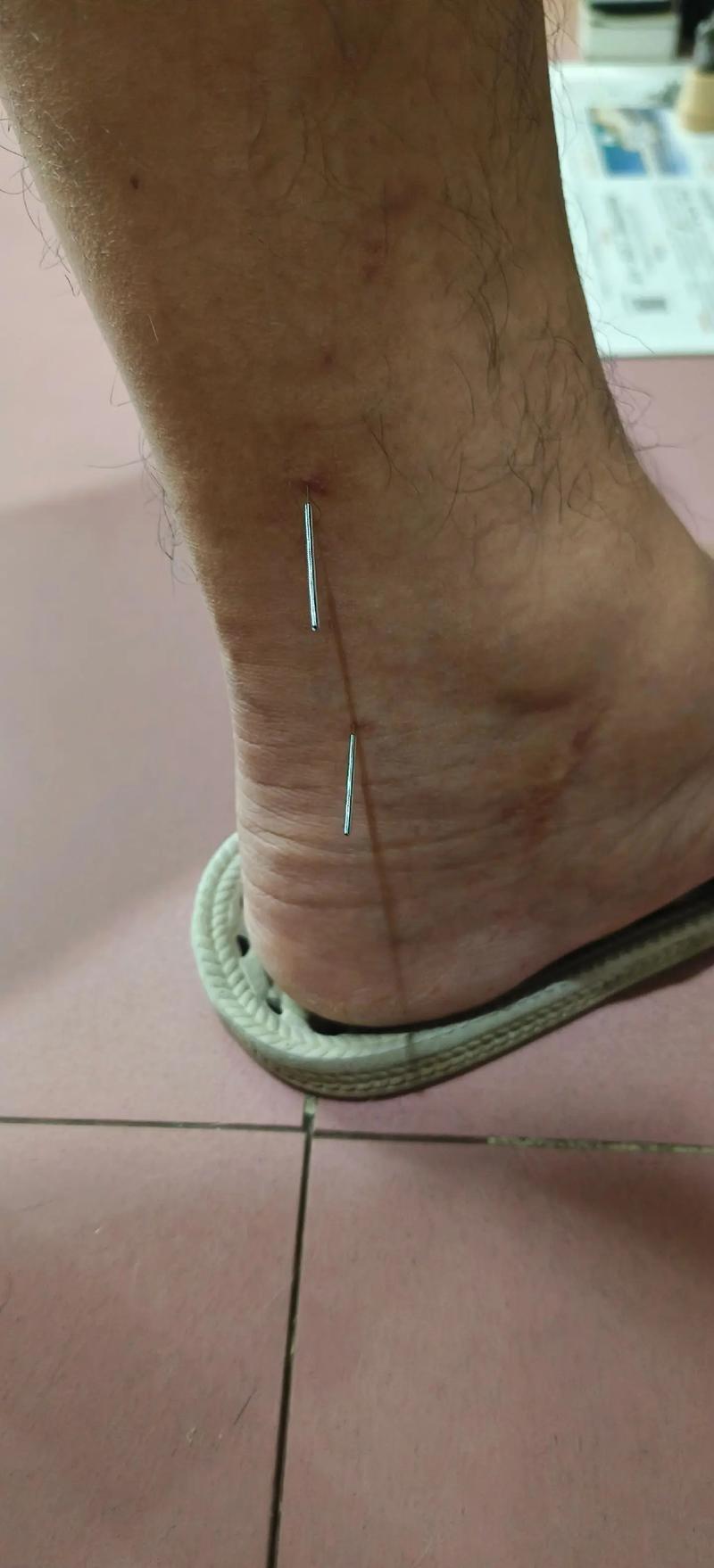 左脚发麻的针灸穴位