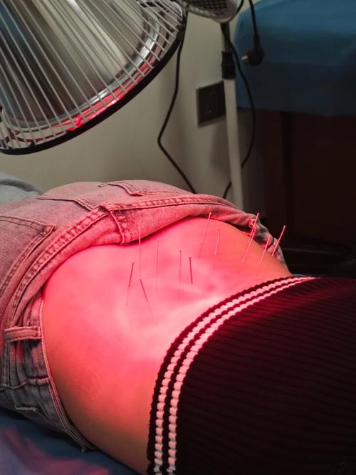 扎腰部针灸全身紧张