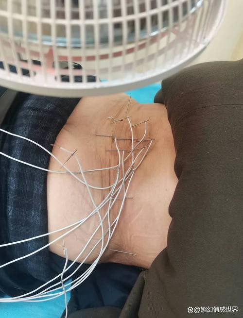 扎腰部针灸全身紧张