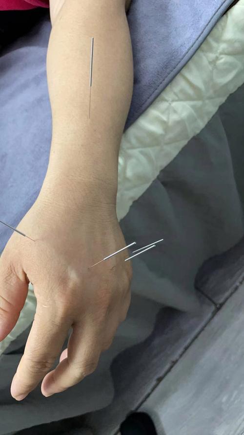 手臂麻木可以针灸吗