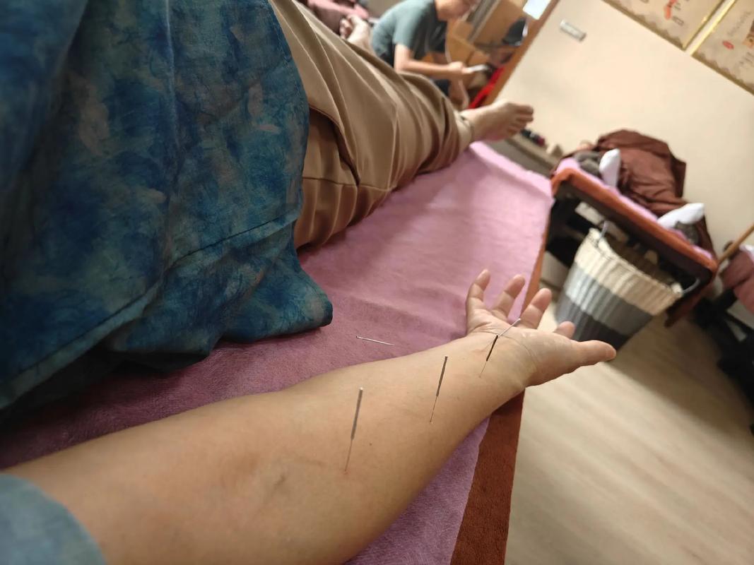 手臂麻木可以针灸吗