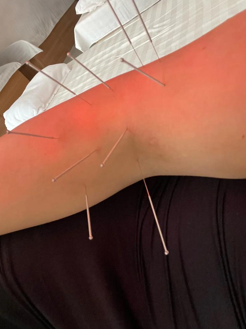 手臂麻木可以针灸吗