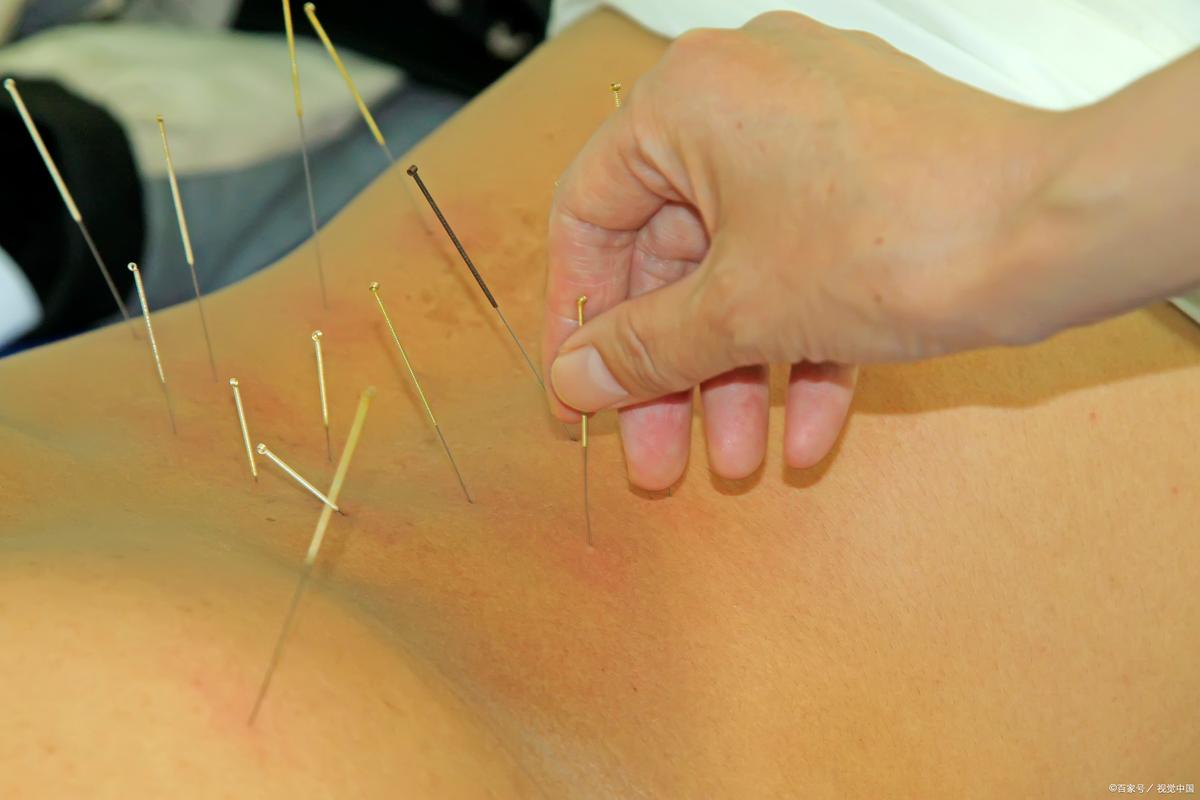 针灸治疗尿床有效吗