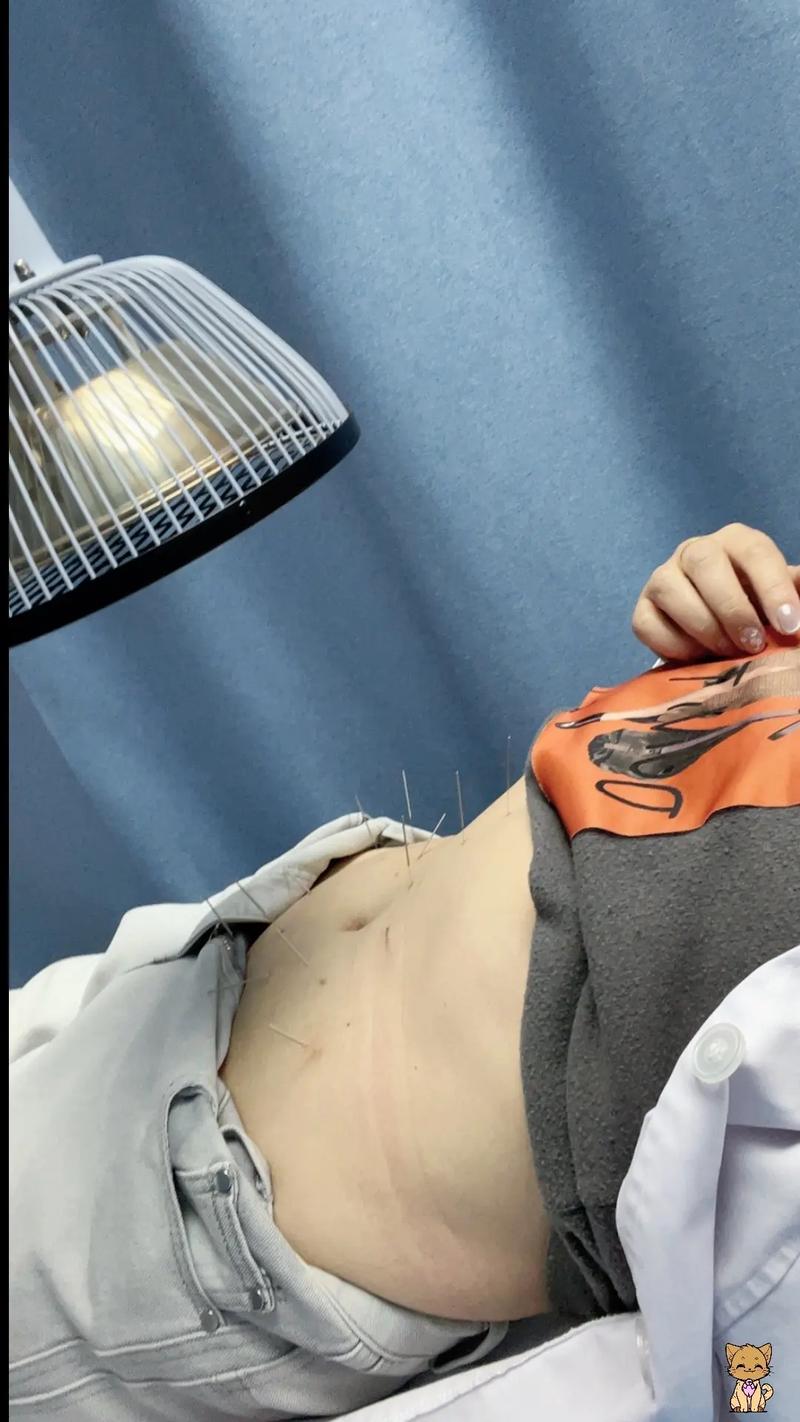 苏州哪里有针灸减肥