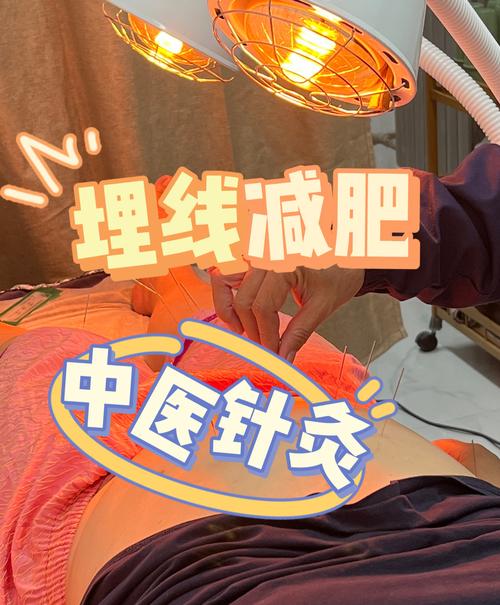 苏州哪里有针灸减肥