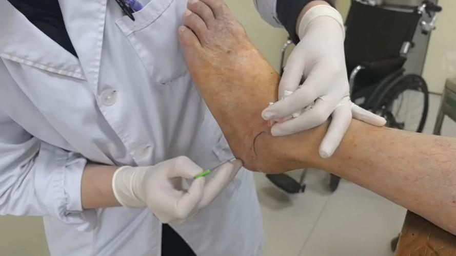 脚踝针灸后肿胀疼痛