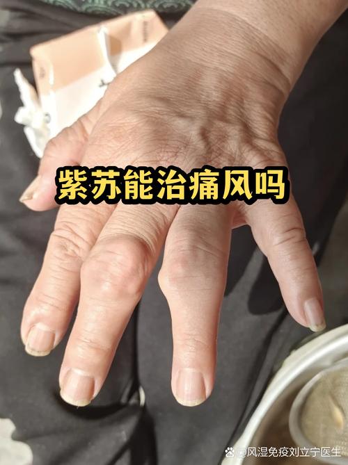 柳树皮泡酒能治痛风