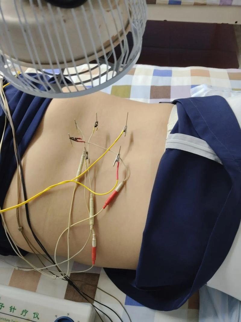 怀孕能做腰部针灸吗