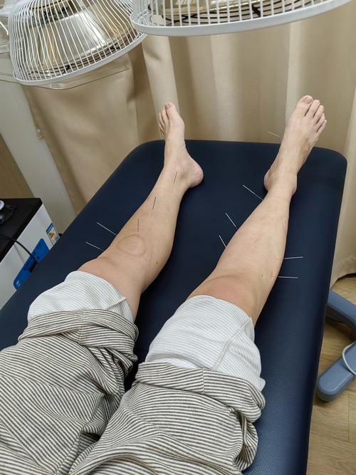 筋骨疼痛的针灸治疗