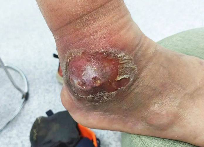 痛风石的地方有积液