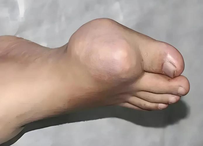 痛风石的地方有积液