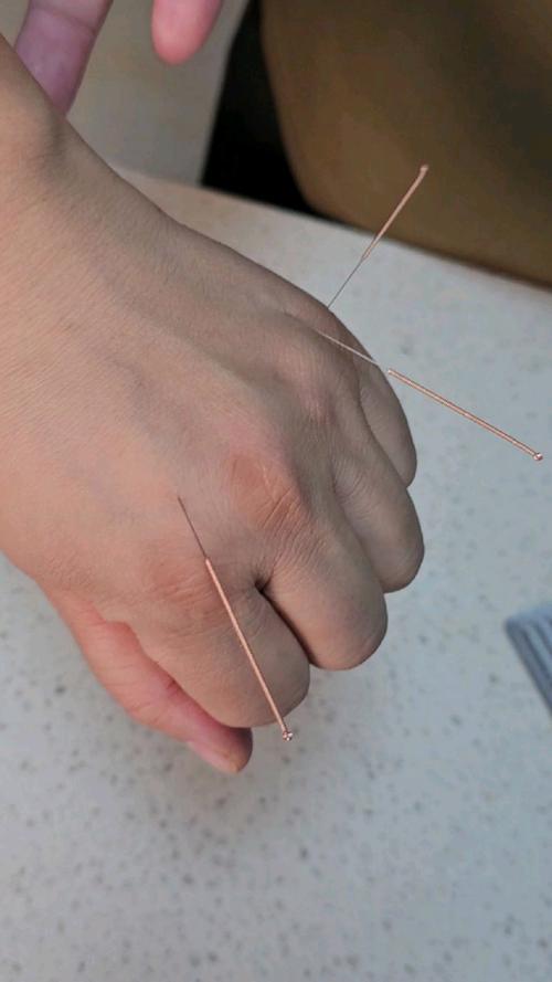 颈椎不好扎针灸好吗