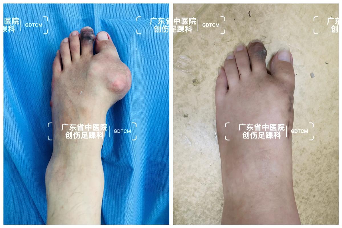 痛风石手术几天能好