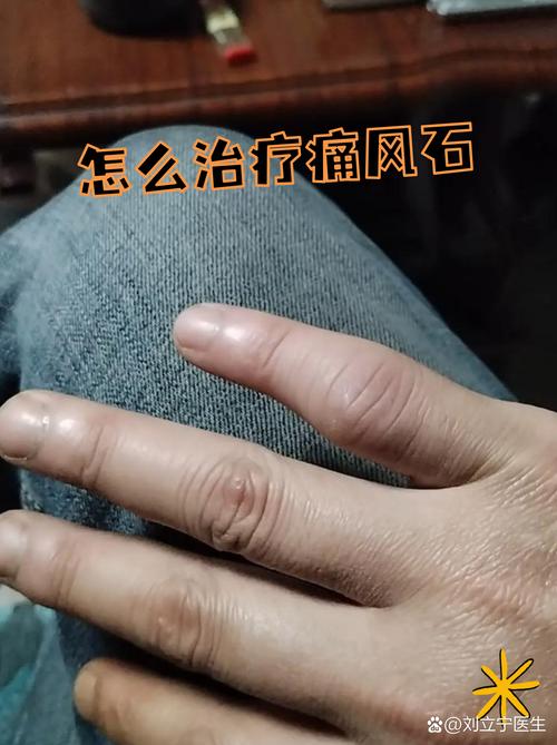 痛风石手术几天能好