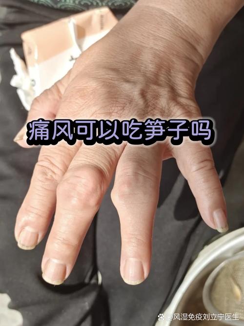 痛风可以吃白芝麻吗